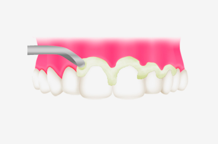 Step１．歯面と歯の隙間の清掃